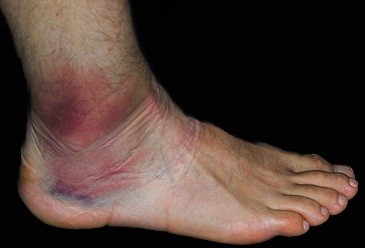 Ankle sprain.jpg