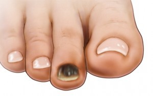 black toe nail.jpg