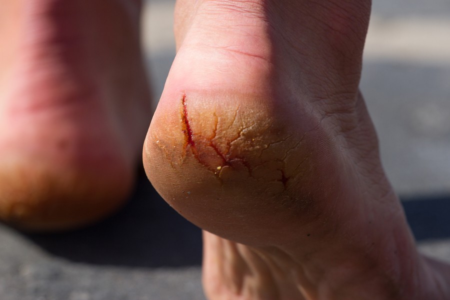 Are Dry, Cracked Heels a Sign of Diabetes? | Cone Health