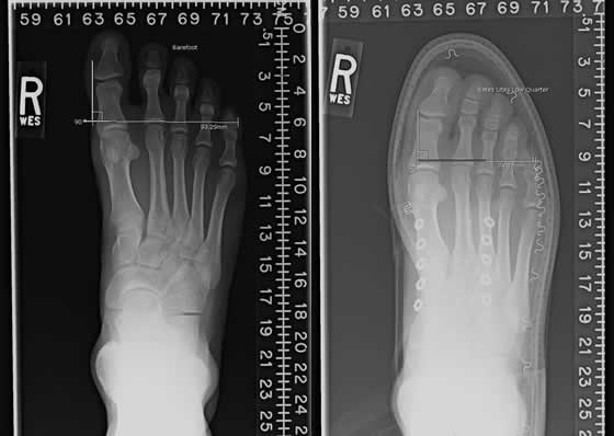 Foot in shoe. X-rayjpg.jpg