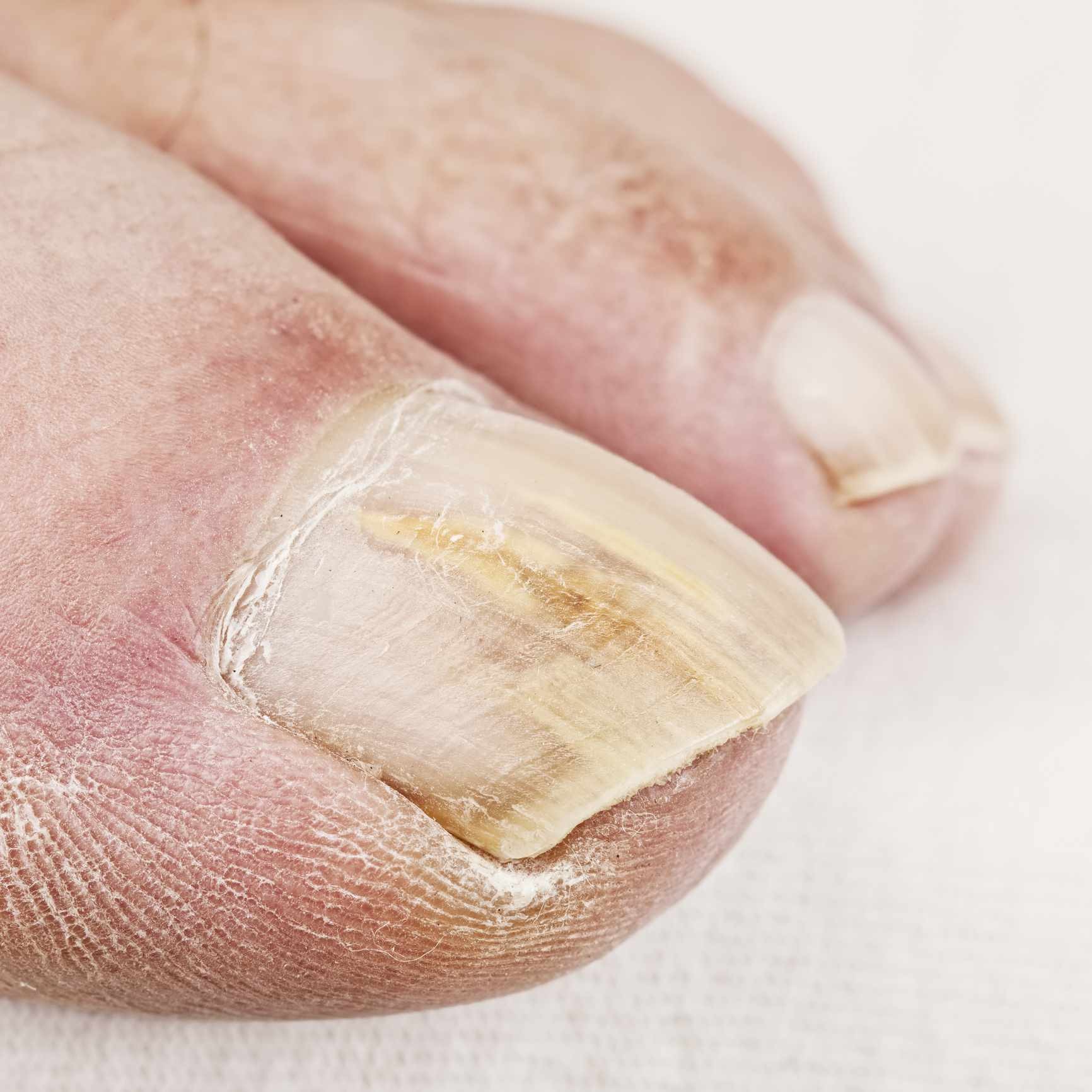 Fungal Nail infection: How does it occur? | Los Gatos, CA Patch